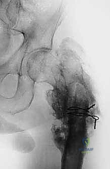 صورة طبية: استئصال عظم الفخذ وإعادة البناء بالطرف الاصطناعي: دليل شامل للمرضى مع الأستاذ الدكتور محمد هطيف في صنعاء