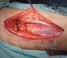 صورة طبية: استئصال عظم الفخذ وإعادة البناء بالطرف الاصطناعي: دليل شامل للمرضى مع الأستاذ الدكتور محمد هطيف في صنعاء