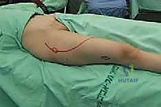 صورة طبية: استئصال عظم الفخذ وإعادة البناء بالطرف الاصطناعي: دليل شامل للمرضى مع الأستاذ الدكتور محمد هطيف في صنعاء