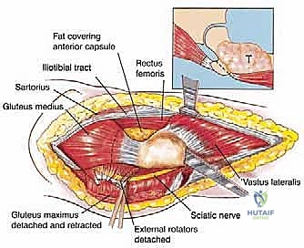 استئصال عظم الفخذ وإعادة البناء بالطرف الاصطناعي: دليل شامل للمرضى مع الأستاذ الدكتور محمد هطيف في صنعاء