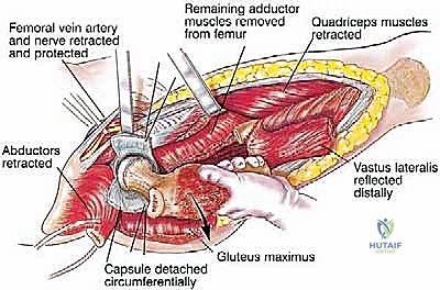 صورة توضيحية لـ استئصال عظم الفخذ وإعادة البناء بالطرف الاصطناعي: دليل شامل للمرضى مع الأستاذ الدكتور محمد هطيف في صنعاء