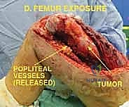 صورة طبية: استئصال عظم الفخذ وإعادة البناء بالطرف الاصطناعي: دليل شامل للمرضى مع الأستاذ الدكتور محمد هطيف في صنعاء