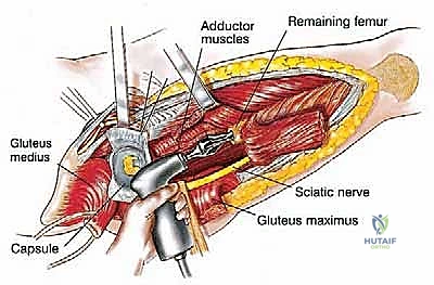 تخطيط ثلاثي الأبعاد لاختيار الطرف الاصطناعي المناسب