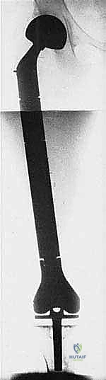 صورة طبية: استئصال عظم الفخذ وإعادة البناء بالطرف الاصطناعي: دليل شامل للمرضى مع الأستاذ الدكتور محمد هطيف في صنعاء