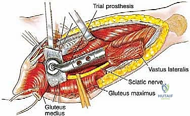 تفاصيل جراحية توضح محفظة مفصل الورك