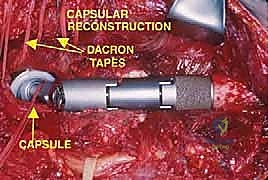 صورة مجهرية لنسيج ورمي بعد أخذ الخزعة