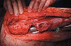 صورة طبية: استئصال عظم الفخذ وإعادة البناء بالطرف الاصطناعي: دليل شامل للمرضى مع الأستاذ الدكتور محمد هطيف في صنعاء