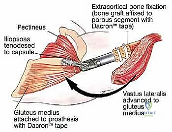 صورة توضيحية لـ استئصال عظم الفخذ وإعادة البناء بالطرف الاصطناعي: دليل شامل للمرضى مع الأستاذ الدكتور محمد هطيف في صنعاء
