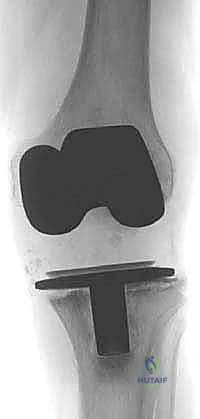 مراجعة مفصل الركبة الصناعي وفقدان عظم قصبة الساق: دليل شامل للعلاج المتقدم مع الأستاذ الدكتور محمد هطيف