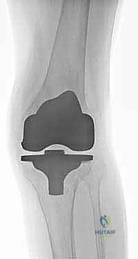 التخلخل العقيم في مفصل الركبة