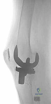 نظرة تشريحية لمفصل الركبة وعظم قصبة الساق