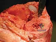 العدوى البكتيرية حول المفصل الصناعي