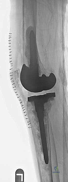 التخطيط الجراحي الرقمي قبل العملية