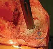 التشخيص الإشعاعي لفشل مفصل الركبة