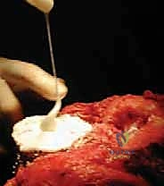 الترقيع العظمي في جراحة الركبة