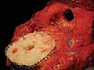 إزالة المفصل الصناعي القديم