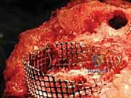 استخدام الإسمنت العظمي في المراجعة