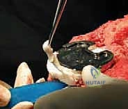 المخاريط المعدنية المتقدمة لتعويض العظم