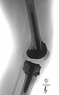 تنظيف وتحضير العظم للمراجعة