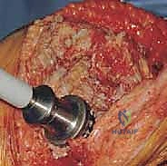 صورة توضيحية لـ مراجعة مفصل الركبة الصناعي وفقدان عظم قصبة الساق: دليل شامل للعلاج المتقدم مع الأستاذ الدكتور محمد هطيف