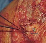 صورة توضيحية لـ مراجعة مفصل الركبة الصناعي وفقدان عظم قصبة الساق: دليل شامل للعلاج المتقدم مع الأستاذ الدكتور محمد هطيف