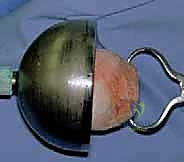 إعادة بناء قصبة الساق بالمخاريط