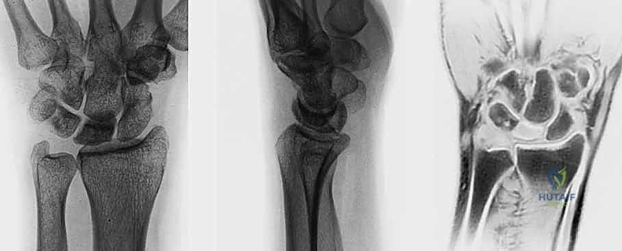 جراحة تقصير العظم الكبير - التخطيط