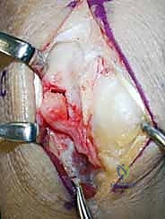 صورة توضيحية لـ مرض كينبوك وخشونة الرسغ: علاج متقدم بجراحة تطويل العظم الوعائي وتقصير العظم الكبير مع الأستاذ الدكتور محمد هطيف