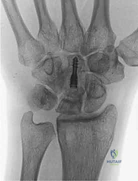 تصنيف مراحل ليختمان لمرض كينبوك