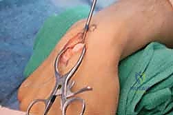 صورة توضيحية لـ مرض كينبوك وخشونة الرسغ: علاج متقدم بجراحة تطويل العظم الوعائي وتقصير العظم الكبير مع الأستاذ الدكتور محمد هطيف