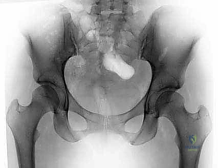 التهاب الغشاء الزليلي والأجسام السائبة