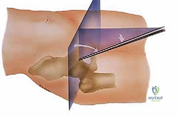 صورة طبية: تنظير مفصل الورك: دليل شامل لعلاج أمراض الأنسجة الرخوة والاصطدام الفخذي الحقي