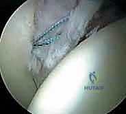 صورة توضيحية لـ تنظير مفصل الورك: دليل شامل لعلاج أمراض الأنسجة الرخوة والاصطدام الفخذي الحقي