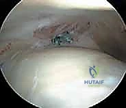 صورة توضيحية لـ تنظير مفصل الورك: دليل شامل لعلاج أمراض الأنسجة الرخوة والاصطدام الفخذي الحقي