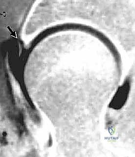 صورة توضيحية لـ تنظير مفصل الورك: دليل شامل لعلاج أمراض الأنسجة الرخوة والاصطدام الفخذي الحقي