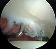 تنظير مفصل الورك: دليل شامل لعلاج أمراض الأنسجة الرخوة والاصطدام الفخذي الحقي