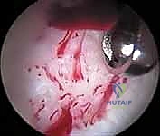 صورة طبية: تنظير مفصل الورك: دليل شامل لعلاج أمراض الأنسجة الرخوة والاصطدام الفخذي الحقي