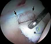 صورة طبية: تنظير مفصل الورك: دليل شامل لعلاج أمراض الأنسجة الرخوة والاصطدام الفخذي الحقي