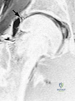 صورة توضيحية لـ تنظير مفصل الورك: دليل شامل لعلاج أمراض الأنسجة الرخوة والاصطدام الفخذي الحقي
