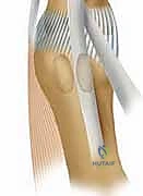 صورة توضيحية لـ دمج مفصل إبهام القدم الكبير: الحل النهائي لخشونة وألم إصبع القدم