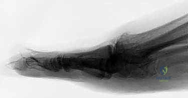 كشط الغضاريف التالفة وتجهيز الأسطح العظمية