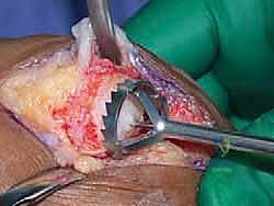 تثبيت الشريحة باستخدام المسامير الطبية الدقيقة