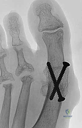 دمج مفصل إبهام القدم الكبير: الحل النهائي لخشونة وألم إصبع القدم