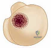 FIG 4 Radiographic findings in osteoarthritis include osteophyte formation especially on the inferior humerus as seen on the AP view A and asymmetrical posterior glenoid wear with posterior subluxation as seen on the axillary view B