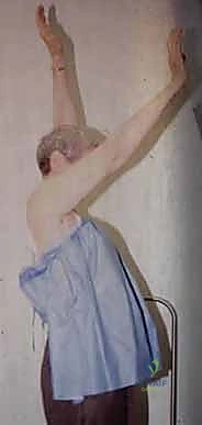 FIG 4 Radiographic findings in osteoarthritis include osteophyte formation especially on the inferior humerus as seen on the AP view A and asymmetrical posterior glenoid wear with posterior subluxation as seen on the axillary view B