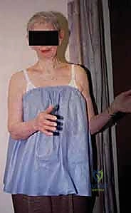 FIG 4 Radiographic findings in osteoarthritis include osteophyte formation especially on the inferior humerus as seen on the AP view A and asymmetrical posterior glenoid wear with posterior subluxation as seen on the axillary view B