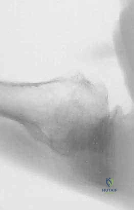 FIG 4 Radiographic findings in osteoarthritis include osteophyte formation especially on the inferior humerus as seen on the AP view A and asymmetrical posterior glenoid wear with posterior subluxation as seen on the axillary view B