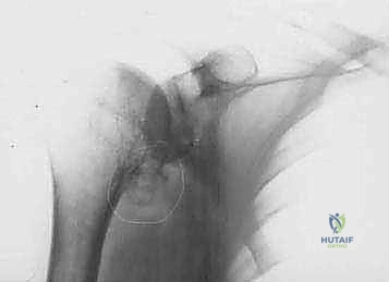 FIG 4 Radiographic findings in osteoarthritis include osteophyte formation especially on the inferior humerus as seen on the AP view A and asymmetrical posterior glenoid wear with posterior subluxation as seen on the axillary view B