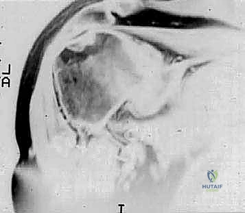 FIG 4 Radiographic findings in osteoarthritis include osteophyte formation especially on the inferior humerus as seen on the AP view A and asymmetrical posterior glenoid wear with posterior subluxation as seen on the axillary view B