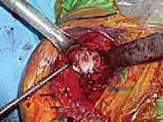 TECH FIG 8 A center pilot hole is drilled in the glenoid surface A and a spherical reamer is used to create a concentric surface B